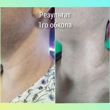 Біоревіталізація шиї. Результат однієї процедури