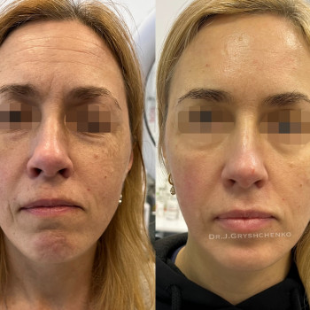 Комплексна робота по омолодженню . Botox full face
Контурна пластика обличчя