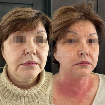 Комплексна робота по омолодженню нижньої третини обличчя 
Ніяких ниток!