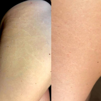 Розтяжки
До і після процедури