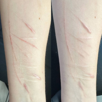 До і пісоя(зроблена 1процедура)
Максимально 4