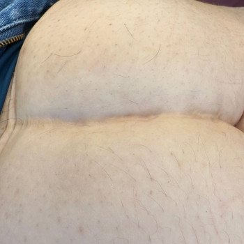 Після,зроблено 3 процедури