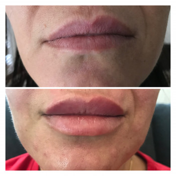 Аугментація вуст,збільшення губ
                    Салон красоты Body Lab XS Сумы