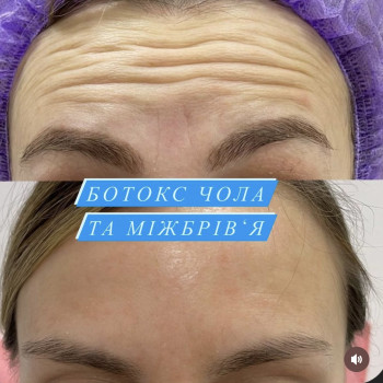 Ботокс