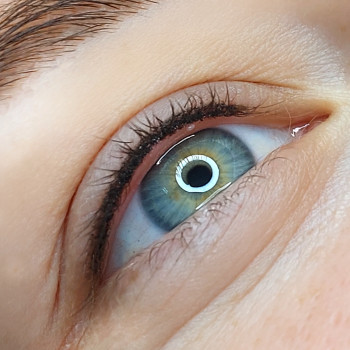 Міжвійка одразу після процедури