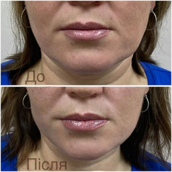 Полімолочна кислота біоревіталізація
                    Врач-косметолог Юлія Луцк