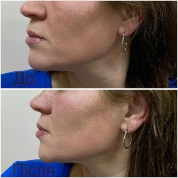 Полімолочна кислота біоревіталізація
                    Врач-косметолог Юлія Луцк