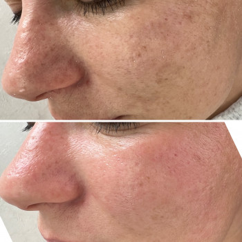 Чистка обличчя та пілінг