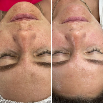 Чистка обличчя