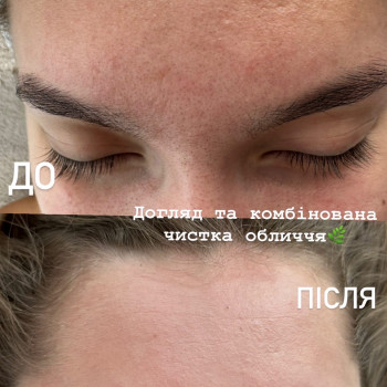 Чистка обличчя та пілінг