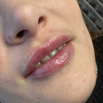 Контурна пластика губ