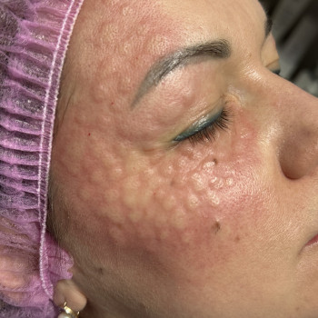 Біоревіталізація