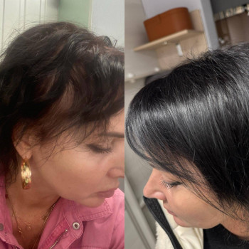 Лікування випадіння волосся