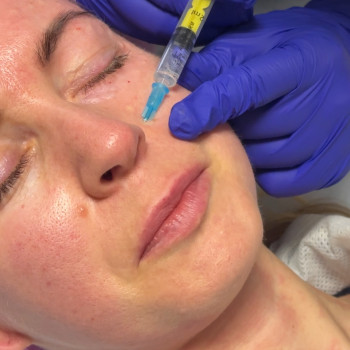 Мезотерапія