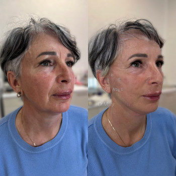 Нитковий ліфтинг