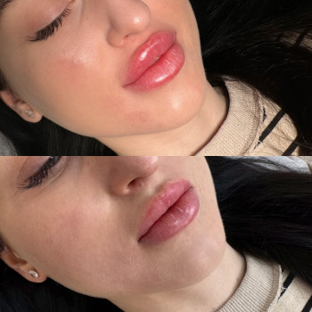 Контурна пластика губ