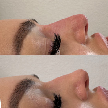 Контурна пластика носа