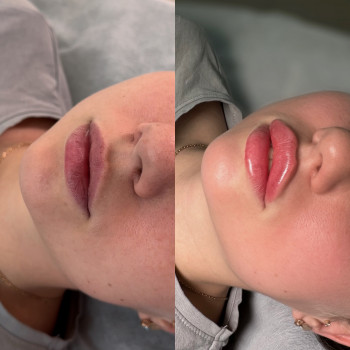 Контурна пластика губ