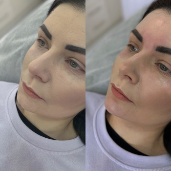 Контурна пластика підборіддя