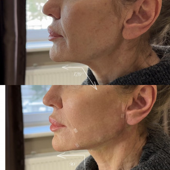 Нитковий ліфтинг