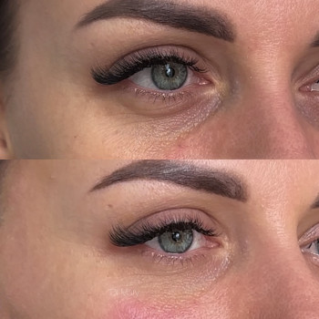 Омолодження зони очей