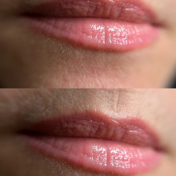 Загоєний Перманент вуст