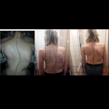 Лечение сколиоза 2-3 степени