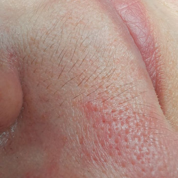 зона-верхня губа(вусики)