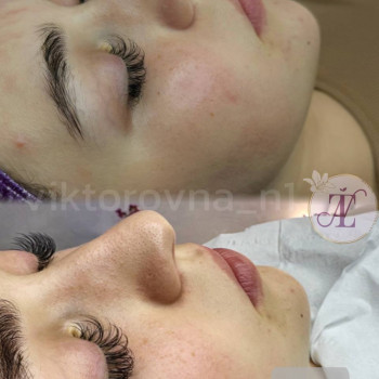 Процедура апаратного очищення обличчя за допомогою ультразвуку