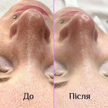 Комбінована чистка обличчя