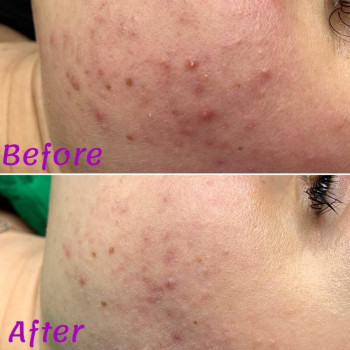 Механічна чистка обличчя