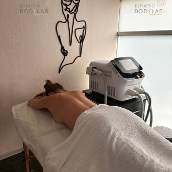 Лазерна епіляція