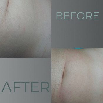 чоловіча електроепілція