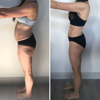 Ультразвукова кавітація для живота
                    Врач-косметолог Юлія Луцк