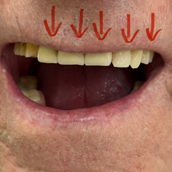Металлокерамические коронки, мостовидные протезы
                    Стоматолог Елена Одесса