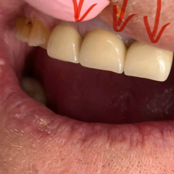 Металлокерамические коронки, мостовидные протезы
                    Стоматолог Елена Одесса