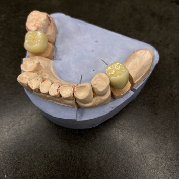 Металлокерамические коронки, мостовидные протезы
                    Стоматолог Елена Одесса