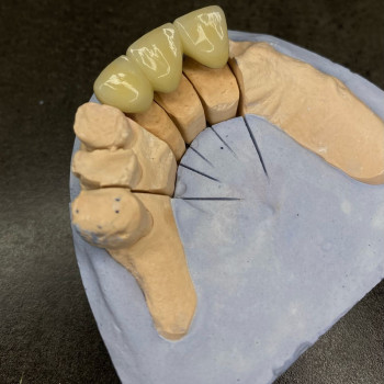 Металлокерамические коронки, мостовидные протезы
                    Стоматолог Елена Одесса