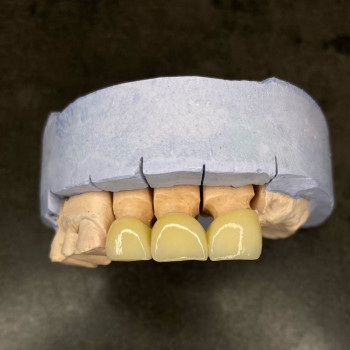 Металлокерамические коронки, мостовидные протезы
                    Стоматолог Елена Одесса