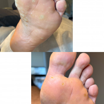 Видалення бородавок
                    Подолог Ксения Киев