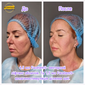  #FacetemS #векторнийліфтинг #контурнапластика