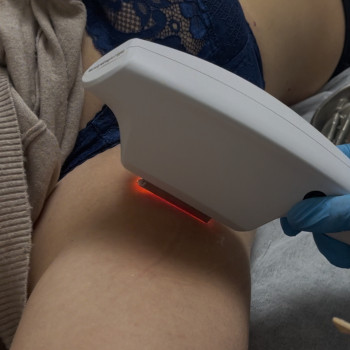 ELOS омолодження, лікування судин, пігментації та акне
                    Косметолог-естетист Наталья Київ