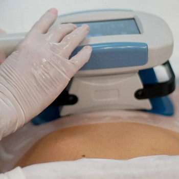 Кріоліполіз живота