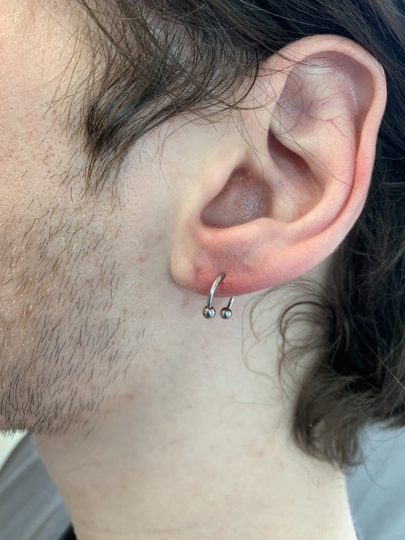 Была успешно пролечена гранулёма , провели зарощение канала и сделан новый прокол мочки уха, фото - Мастер по пирсингу Татьяна Ананьева