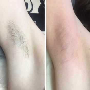 видалення волосся
 