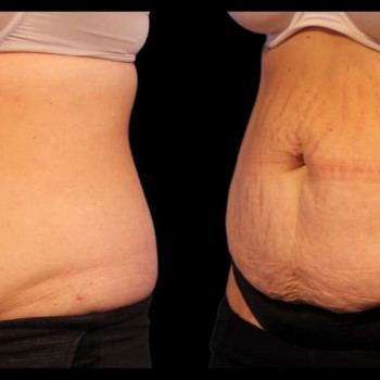 Кріоліполіз живота