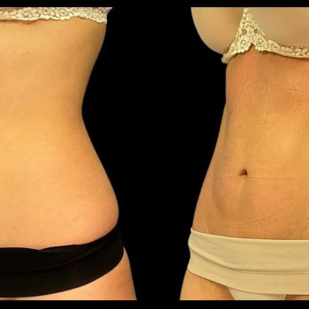 Кріоліполіз живота