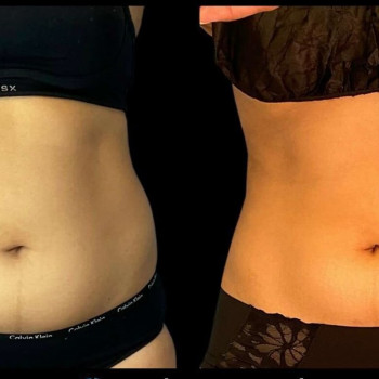 Кріоліполіз живота