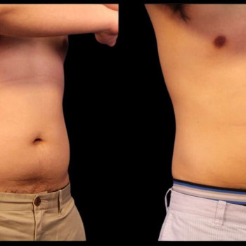 Кріоліполіз живота