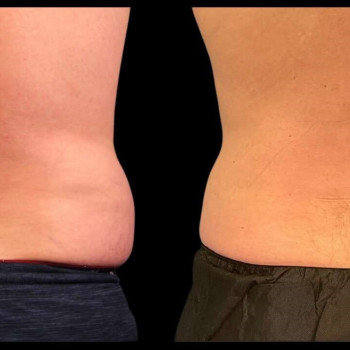 Кріоліполіз бока (спина) Чоловік